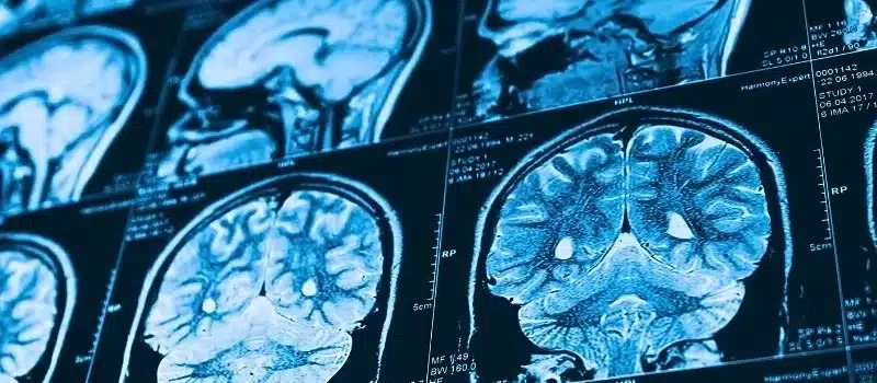 Close up series of a CT scan with human head on it. X-ray medicine concept. traumatic brain injury vs concussion