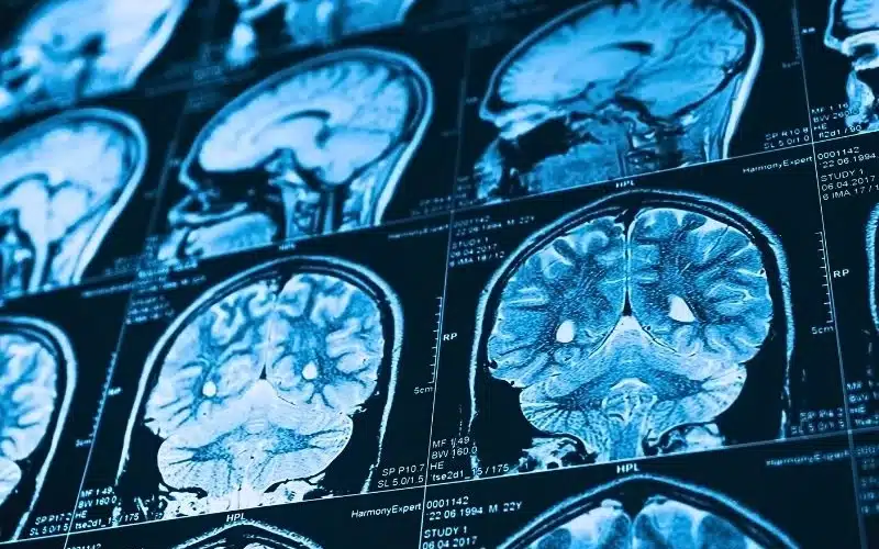 Close up series of a CT scan with human head on it. X-ray medicine concept. traumatic brain injury vs concussion