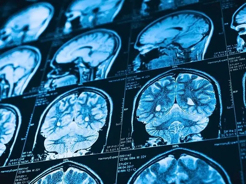Close up series of a CT scan with human head on it. X-ray medicine concept. traumatic brain injury vs concussion