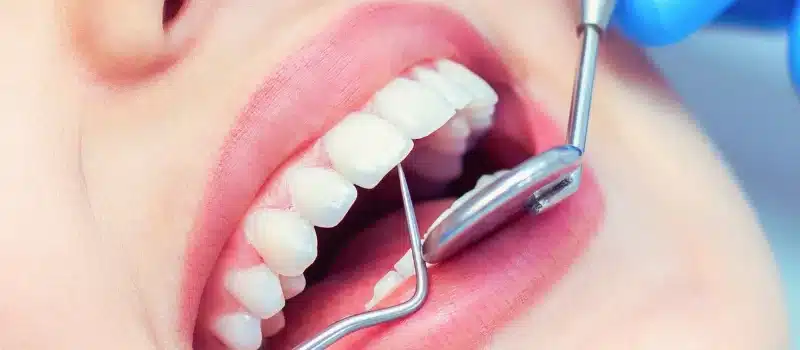 Healthy teeth of a woman being checked by a dentist.