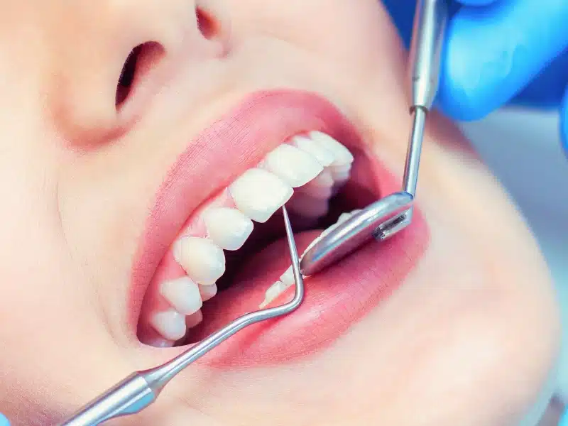 Healthy teeth of a woman being checked by a dentist.